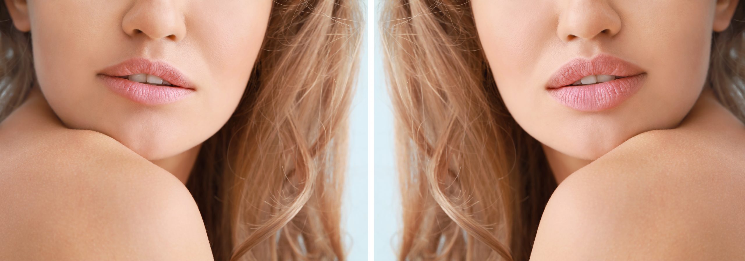 LIP FLIP IN VANCOUVER - LIP INJECTIONS